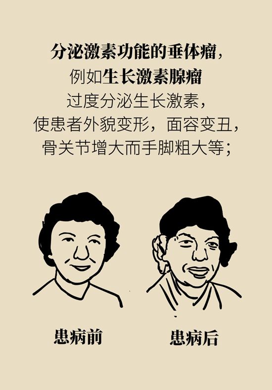 内分泌失调|变丑、变胖、内分泌失调……这些糟心事警惕脑肿瘤