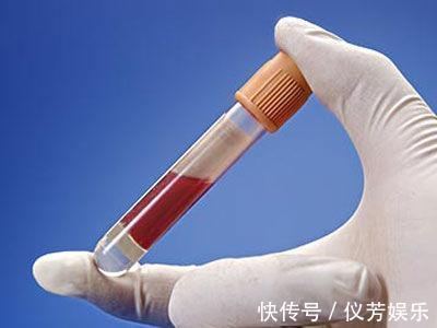 血脂|碳水化合物是高血脂的“催化剂”吗医生除了糖,这3物要忌口