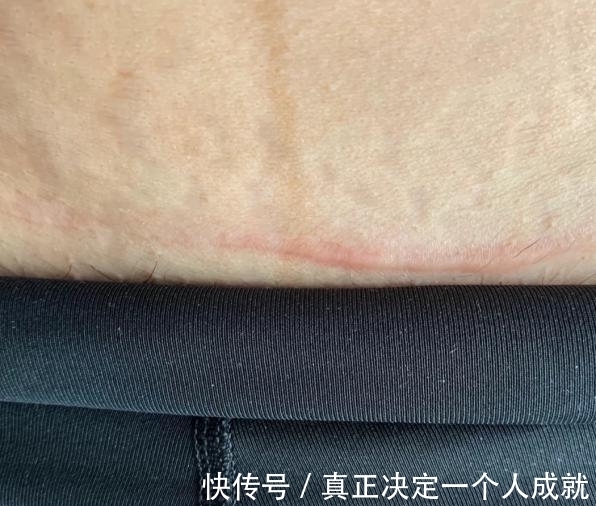 身体|剖腹产两次,身体会有什么变化?