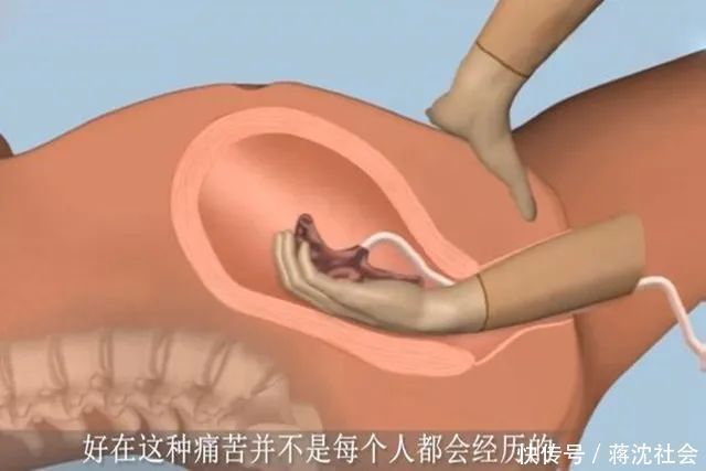 妈妈们|为什么有些产妇生完孩子后,胎盘不能自动娩出,还需要手剥胎盘