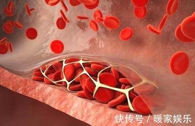 碳水化合物|血栓的“凶手”找到了，此4种食物要少吃，能减少血管堵塞