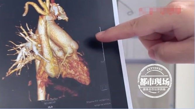 浩浩|十月大婴儿一运动就嘴唇发紫，医生：孩子心脏有问题