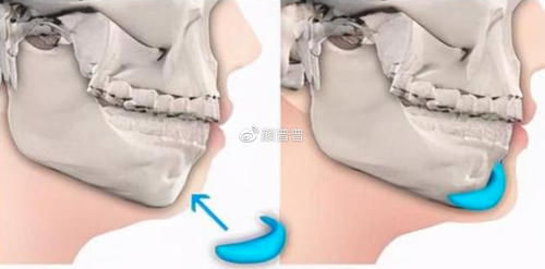假体|颏成型术和假体垫下巴有啥区别?下巴短还后缩做哪个好?