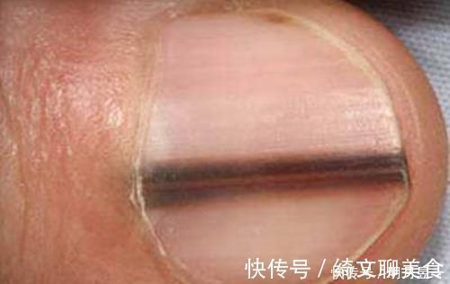 黑线|指甲里的黑线是什么?真有1种可能会癌变,不是开玩笑,别小瞧