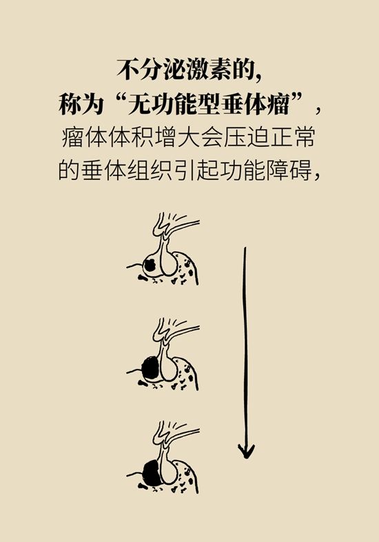 内分泌失调|变丑、变胖、内分泌失调……这些糟心事警惕脑肿瘤