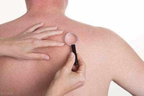 后背长痘怎么办？想拥有光滑后背，不妨试试这个方法！