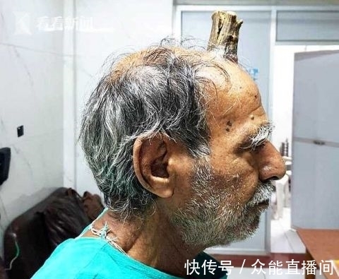 理发师|印度老人跌倒后头上长角 理发师越剪越长如今10厘米