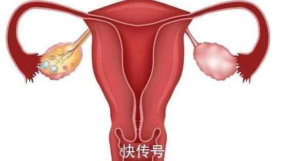 子宫萎缩|上环的女人,到了此年龄,节育器就要取下来,不然子宫会受伤害