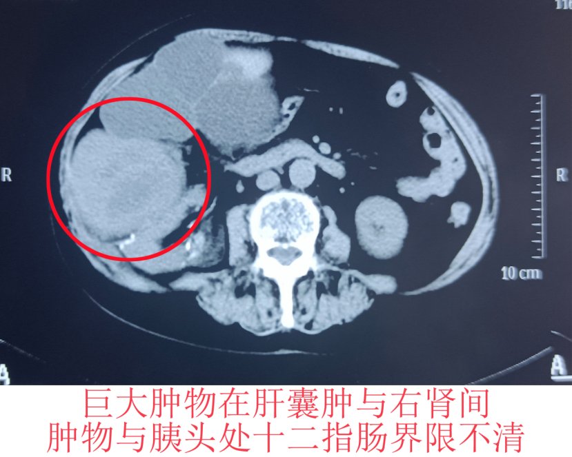 腹膜|哈医大一院群力多学科联合微创切除复杂后腹膜巨大脂肪肉瘤