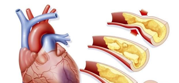  血管|辟谣：动脉粥样硬化不可逆？案例：45岁患者减少血管狭窄20%