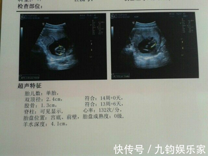 检查|怀孕后成功闯关这5次孕检，孕妇可以放宽心了，宝宝会健康到来