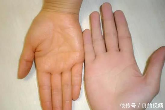 肝脏好不好,都“写”在手上了,手上若无3种“异常”,肝还不错