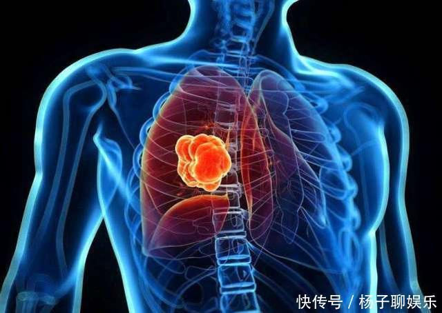 咳嗽|肺部上有肿瘤，从睡眠先知道，如果你有3种睡眠问题，别分心