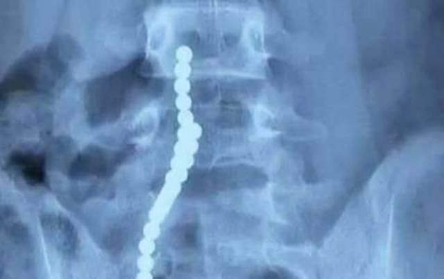 入院|5岁宝宝误吞磁力球入院，医生提醒这些东西很危险趁早全部扔掉