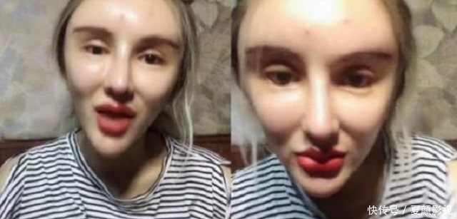 “粉红宝宝”:为了美13年整形200多次,现在只能坐在轮椅上