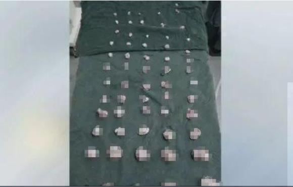 顾女士|38岁女性腹痛不止,医生在她子宫中取出大大小小61个,从未遇到过