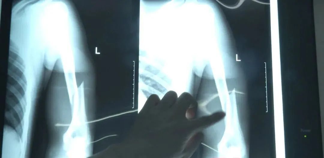 骨质疏松|小伙儿掰手腕，手臂竟断了！医生诊断令人震惊……