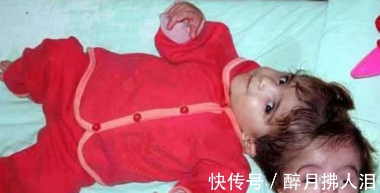 诺拉|小女孩从小有“双头”,进行割头手术