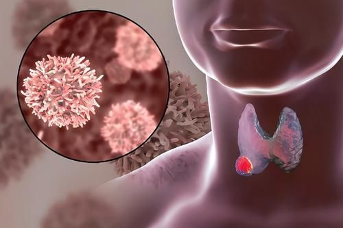 泡水|甲状腺结节的“祸根”被发现,三种食物,切莫贪嘴