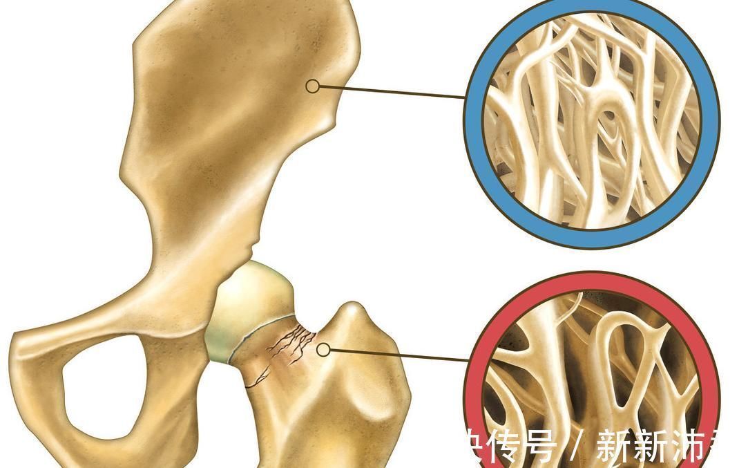 营养均衡|骨质疏松的症状有哪些?吃什么食物可预防骨质疏松?