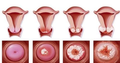 肝硬化|从炎症到“癌变”,一般需要多久?这3种炎症,请尽早治疗