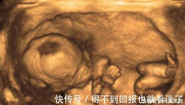 四维彩超|孕期,做“四维彩超”时能看出宝宝性别或许聪明孕妈都能看明白