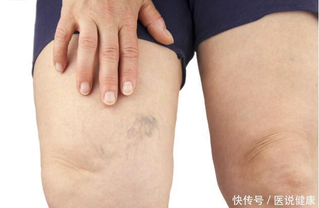 血管硬化有4个症状！忠告：坚持“3多2少”，血管慢慢恢复弹性