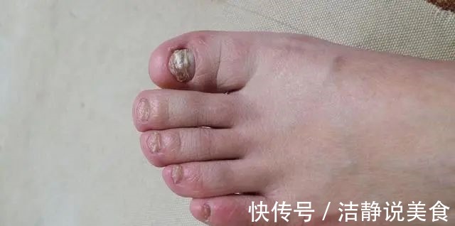 血脂|血脂高不高,看小腿就懂若有这4种症状,或在暗示血脂偏高了