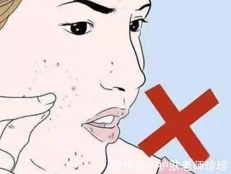 痘印|教你怎么样祛痘痘,快速祛痘祛痘印