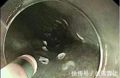 胸骨|明明是慢性咽炎,胃镜查出食管癌!医生忠告:出现这些症状别大意