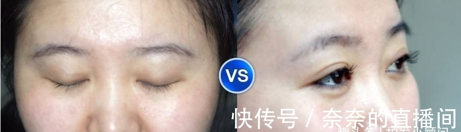 眉毛 毛发移植除了植发还有什么项目？