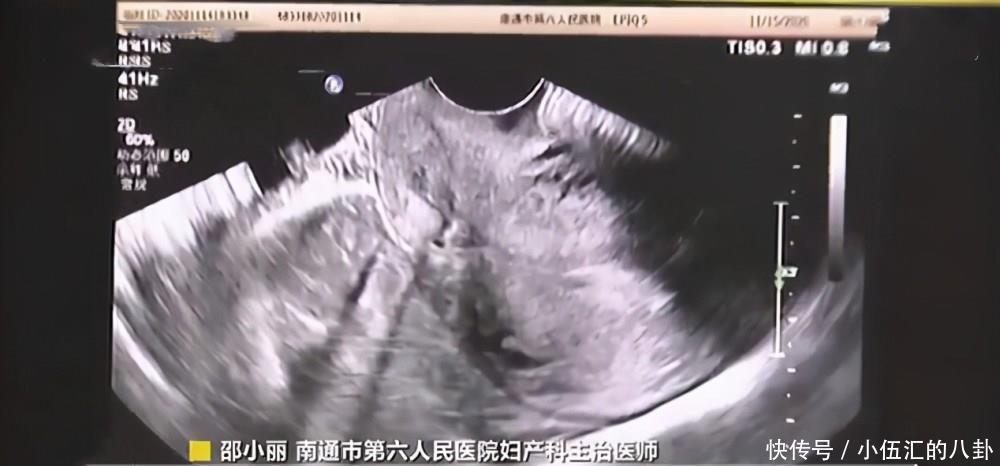 怀孕|39岁女子宫内宫外同时受孕“鬼门关”外走一遭