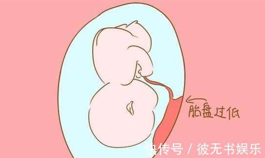 孕妇|若你怀孕时,“胎盘低”的原因是什么?对胎儿有什么影响吗?