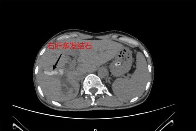 恒生医院|深圳恒生医院利用钬激光碎石术为患者取出数十枚肝内胆管结石