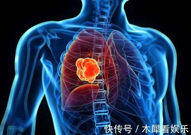 肿瘤|肺部上有肿瘤，从睡眠先知道，如果你有3种睡眠问题，别分心