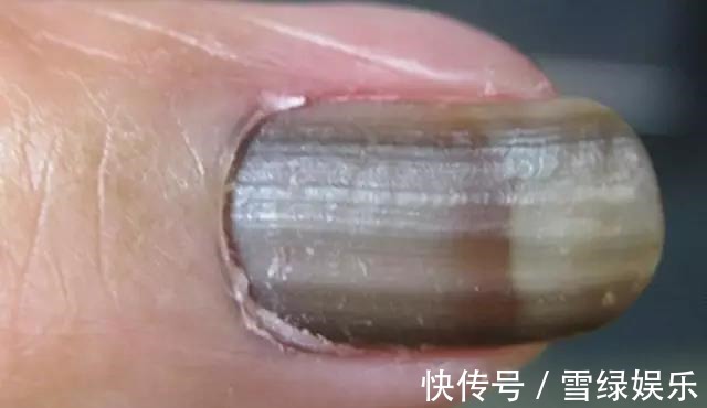 癌症|指甲上有黑线，可能是最恶的癌症，医生教你怎么办