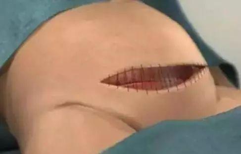 妈妈|剖腹产手术全过程!只有躺在产床上的妈妈,才知道那种滋味