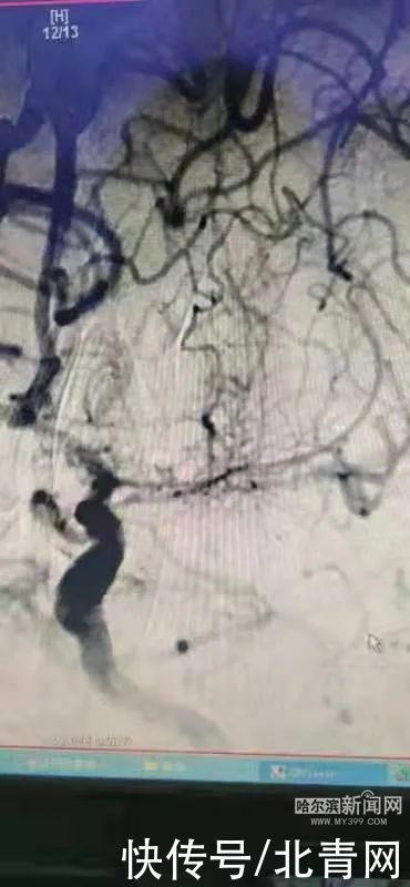 烟雾病|头晕反复犯，三两天就好？医生一查：脑袋里“少根儿筋”