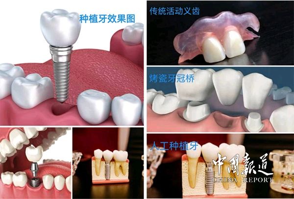 种植牙|衡南县人民医院引进新口腔CT（CBCT）与种植牙技术