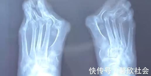 高跟鞋 爱穿高跟鞋的女性一定要小心,拇指外翻堪比“裹脚”!不可忽视