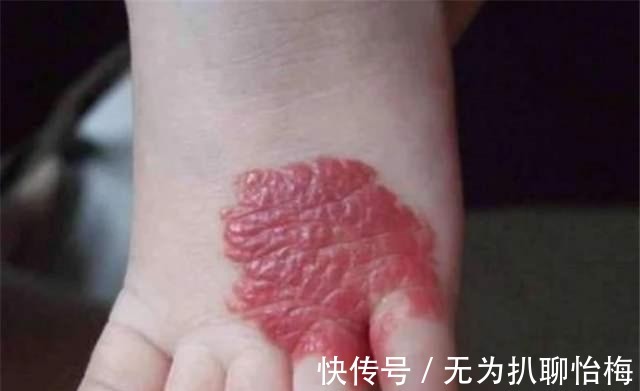 举动|孩子的“胎记”哪来的?作为母亲要知道,孕妈的这些举动是元凶