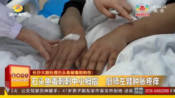 长沙|被鱼刺扎一下，长沙男子紧急送医！医生：这种鱼刺6根可致死！