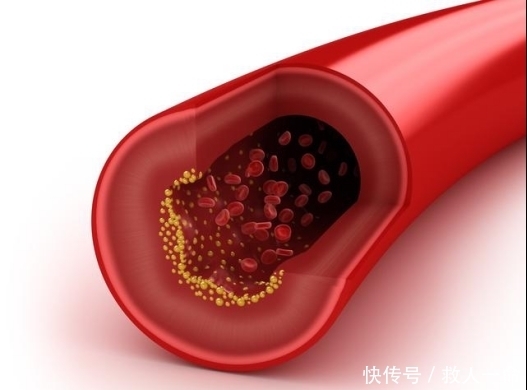  血脂|高血脂的根源并不是肉，这4样食物不忌口，血脂只增不减