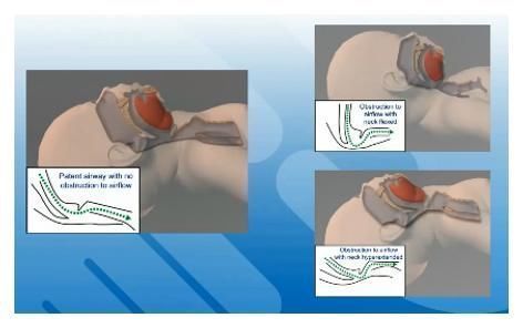 新生儿|宝宝出生后全身青紫,急救只用4分钟!这个方法得学!