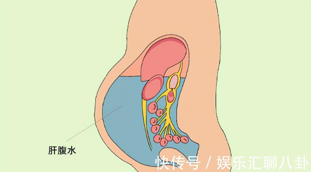 乳酸|早期肝硬化,身体会浮现出“9大症状”,占一半以上,要及时就医