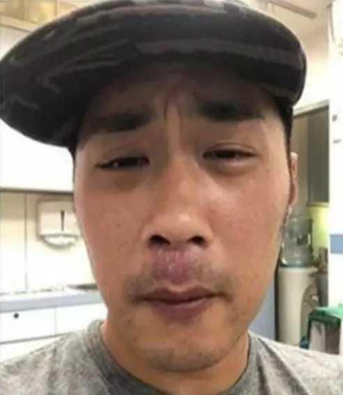 大肠癌|琪琪时隔7年大肠癌再复发！医生直言束手无策，此前已化疗50余次