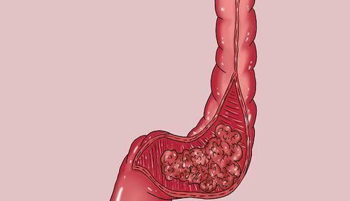 肿瘤|癌症患者，到底是吃肉好还是吃素好？肿瘤医生：需谨记4个字