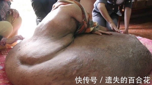 男子|男子的腿长成了一块“大岩石”，天天坐在上面，画面让人害怕