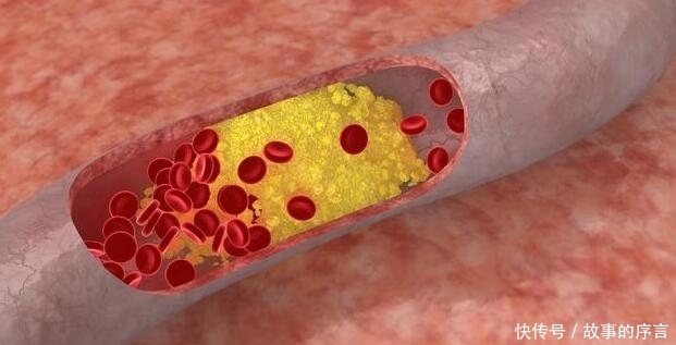  为何“高血脂”的人越来越多？原因逃不出“3个字”