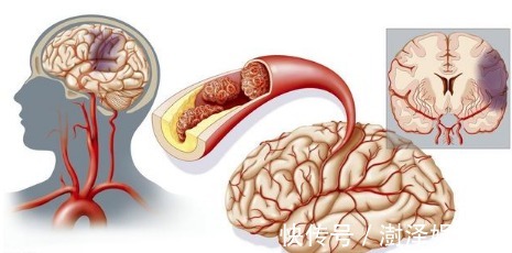 动脉粥样硬化|老护士长儿子31岁高血压5年，突发脑梗偏瘫失语！留下只有遗憾